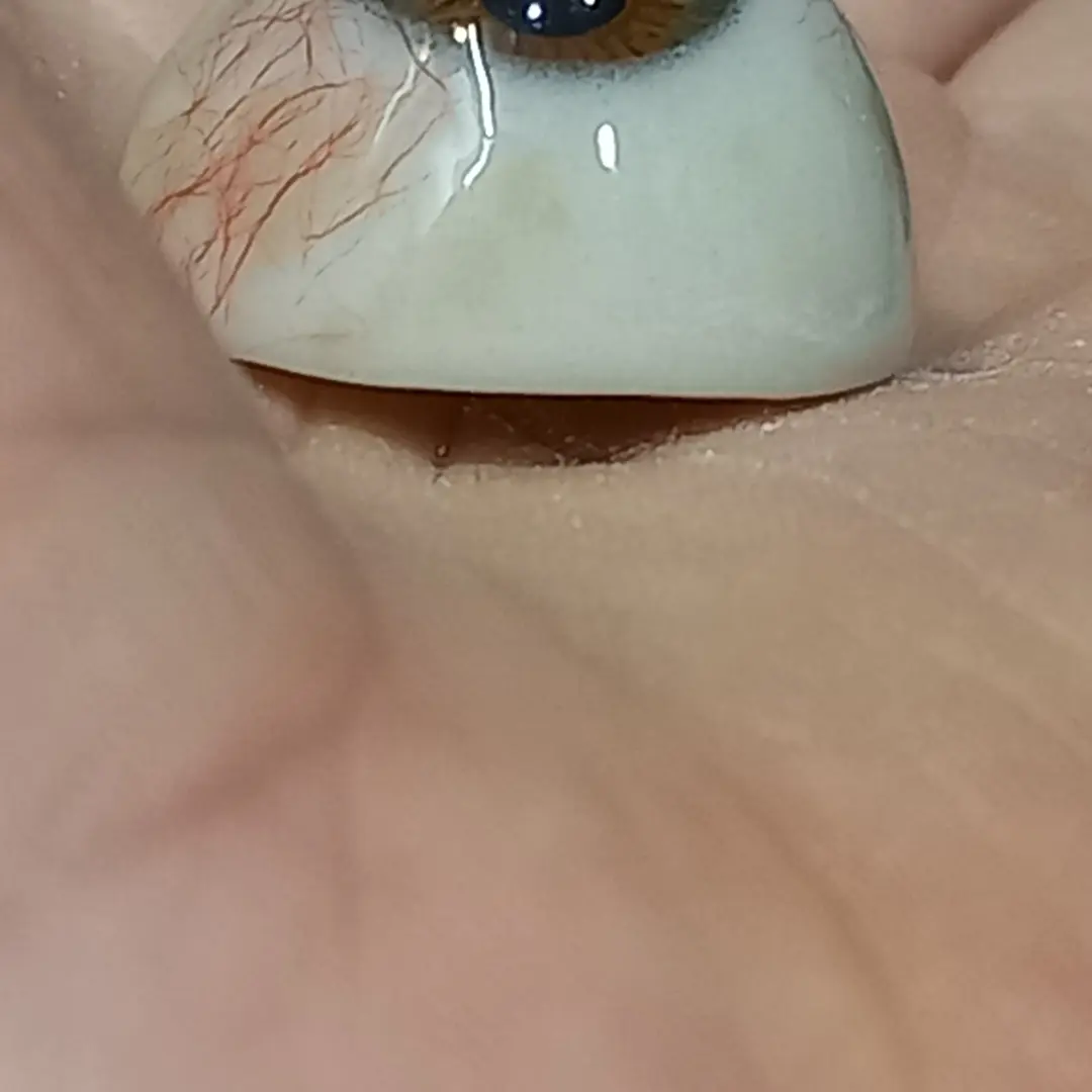 Prótesis ocular con iris azul verdoso siendo colocada cerca del ojo