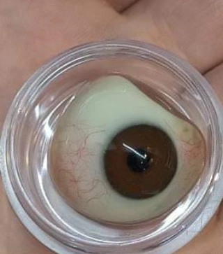 Prótesis ocular con iris marrón en frasco de almacenamiento