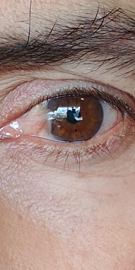 Prótesis ocular artesanal con iris café pintado a mano