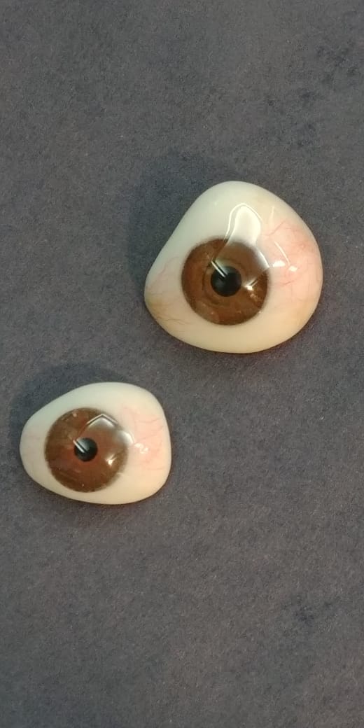 Resultado de prótesis ocular en paciente adulto, aspecto natural integrado
