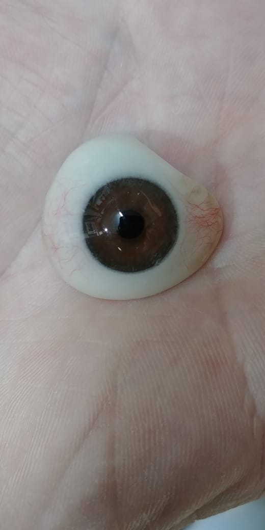 Paciente con prótesis ocular adaptada mostrando resultado natural en el ojo