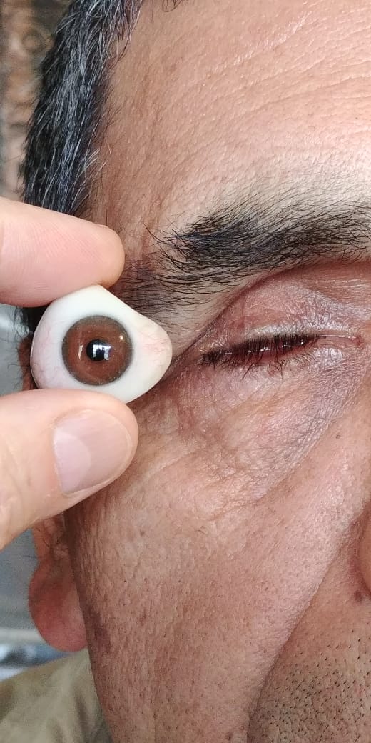 Dos prótesis oculares artesanales de diferente tamaño fabricadas en Concepción Chile